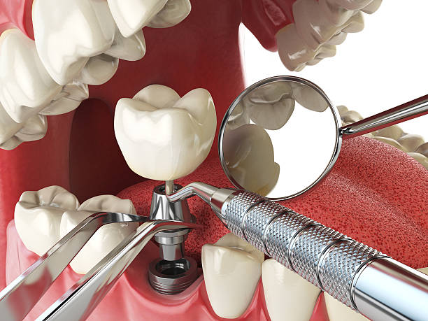 Best Emergency Dentist for Lost Fillings or Crowns in Krugerville, TX